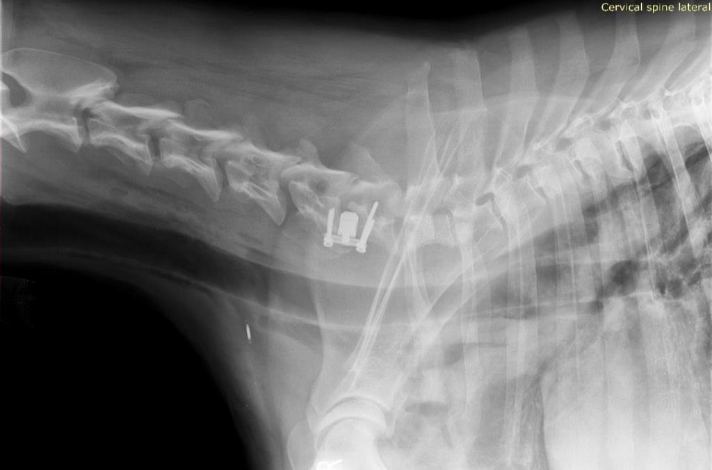 10. ábra: Latero-laterális postoperatív felvétel, Sunny A távtartó helyzete jó, mélyen ül a csigolyaközben, de markáns disztrakció