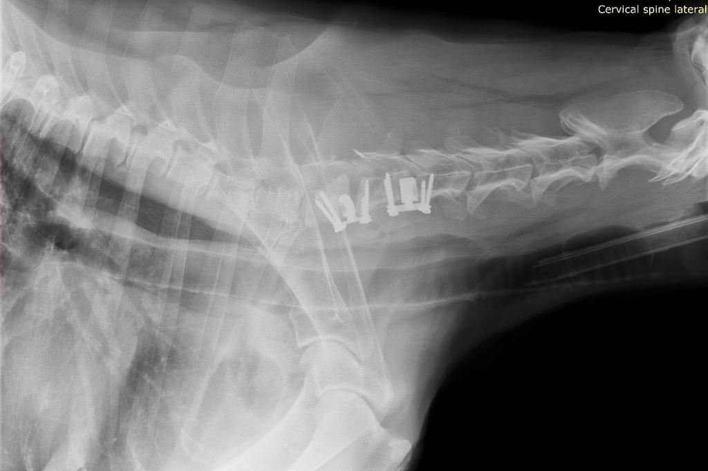 13. ábra: Postoperációs felvétel, Rozi A távtartók helyzete megfelelő, a C6-7-es csigolyaköz jelentősen tágabb lett. (Forrás: ÁTE, Sebészeti és Szemészeti Klinika, röntgenarchívum) 4) Bíbor 2017.04.