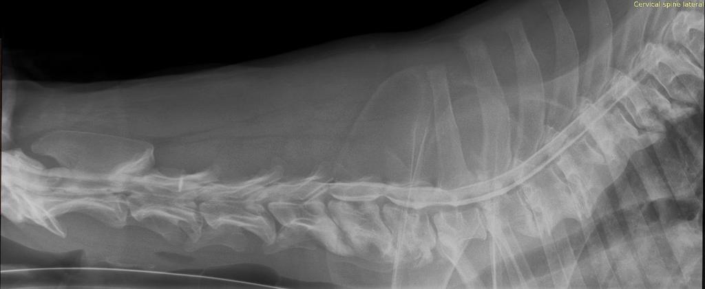 14. ábra: Preoperációs myelográfia, Bíbor A kontrasztanyag radiolucens fehér vonala a C5-6 és C6-7-es csigolyaközök felett is