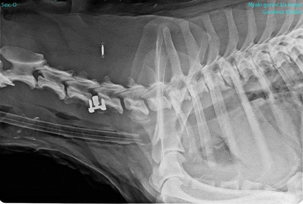 A műtét során ventralis feltárásból, EasyFix-TTA távtartót helyeztünk be a C4-5-ös csigolyaközbe, lemezt ezúttal nem alkalmaztunk.