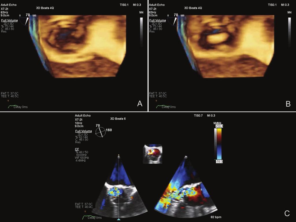 elhelyezkedő vegetációnak imponáló képlet Az adatok alapján (endocarditisre nem jellemző hemokultúra és TEE-vizsgálat) az aktív endocarditis kizárhatóvá vált, viszont a jelentős regurgitáció miatt