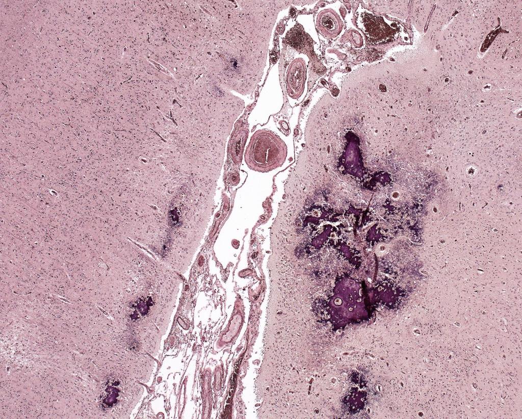 Anti-foszfolipid antitestek okozta