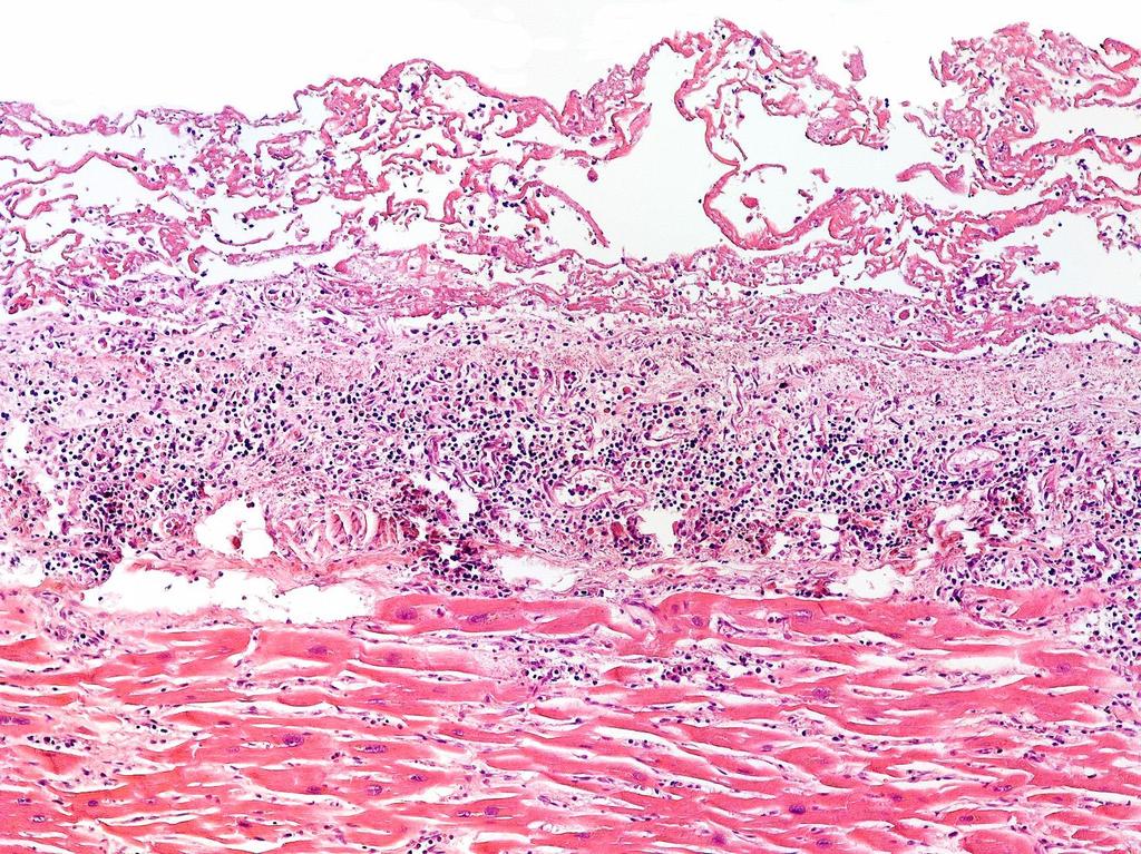 Pericarditis.