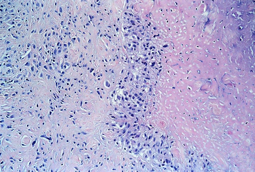 Rheumatoid csomó: centralis fibrinoid