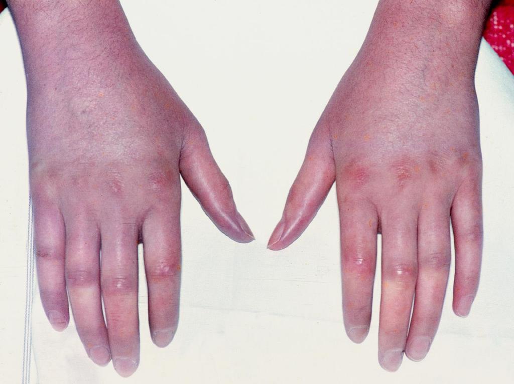 A dermalis fibrosis akadályozza az ujjak