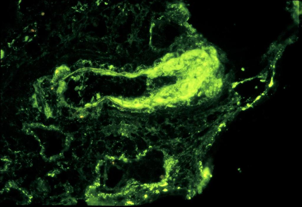 Immunpathológia: IgG, C3, DNS