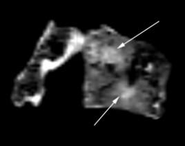 ábra: Szklerotikus és litikus léziók MPR CT-rekonstrukciók, ágyéki csigolya. Fig. 15: Sclerotic and lytic lesions MPR CT reconstructions (lumbar vertebra).