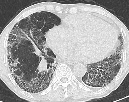 UIP HRCT morphológiai jelei subpleuralis, bazális irregularis reticularis rajzolat tüdő