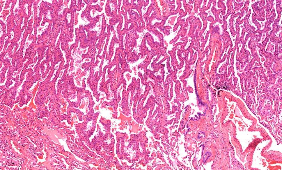 AGés Kadotagrádus szerint lepidikus carcinoma