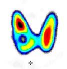 Tc-MDP ( 99m Tc-methyl