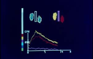 inkább 99m Tc pertechnetát Na 99m TcO 4 Λ az izotóp beadása exponenciális T eff Images from: Biassoni Chippington: Imaging in