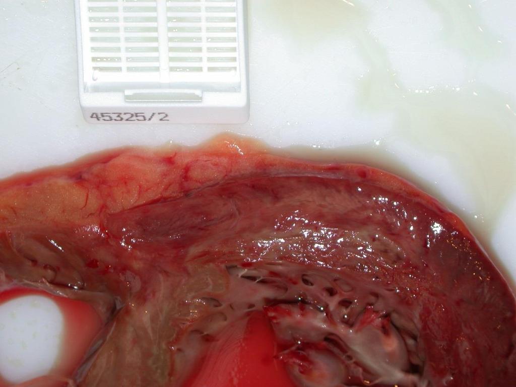 AMI morfológiája 1-3 napon: - Coagulatios necrosis tovább progrediál - Neutrophil granulocyták nagyfokú