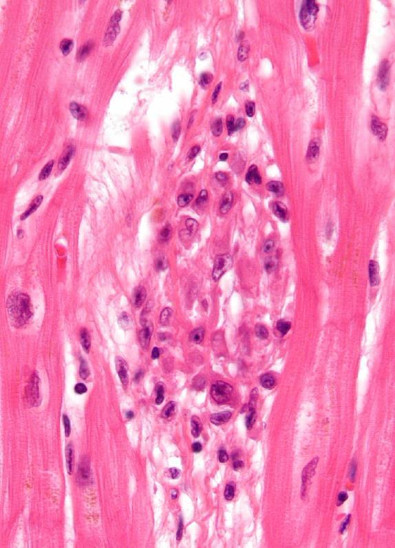 Rheumás láz - akut Érintett szövetekben kis gyulladásos fókuszok -> Jones-kritériumok: (legalább kettő kell) carditis migráló polyarthritis migráló