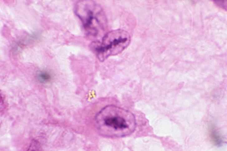 exuadatum - Myocarditis - Billentyűn fibrinoid necrosis és depozíció 1. 2. 1. By Ed Uthman, MD - http://www.flickr.