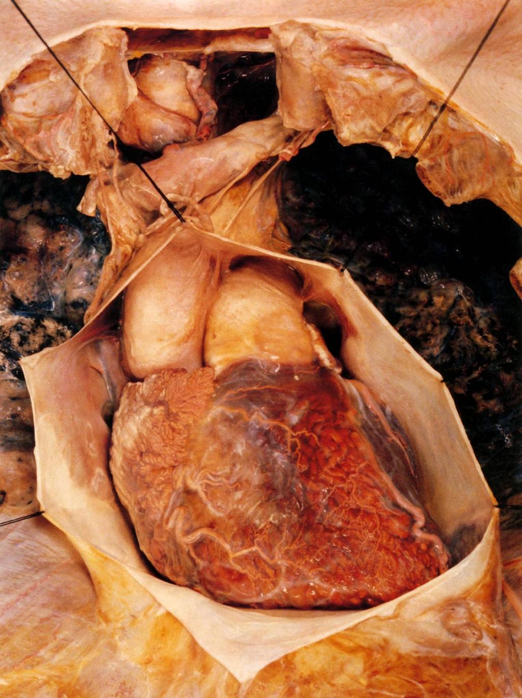 A felnyitott szívburok (jól( l l látszik a parietalis pericardium külső, fibrózus rétege, amely a rekesz felszínéhez rögzr gzül) A pericardium két t rétegr tegének ún.