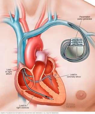 A szív működésekor keletkező elektromos impulzusokat a bőr felszínén mérni lehet. Ennek grafikus megjelenítése az EKG.