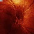 Elülső Ischémiás Opticus Neuropátia (AION) - differenciál diagnosztika Arteritiszes AION < <Nem arteritiszes-aion Pathofiziológia nagy-/közepes artériák vég artériák