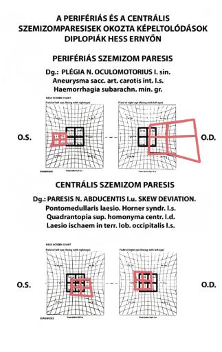 hirtelen kezdettel átmeneti vagy tartós kevésbé zavaró diplopia - centrális nem
