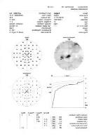 / IDEGSEBÉSZETI NEURO-INTERVENCIÓ (AV duralis fistula, traumás FCC) cerebelláris infarctus:craniektómia hydrocephalus - shunt implantáció SSS stenosis - endovascularis stent implantació 5.