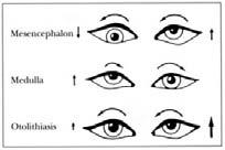 STROKE - OCULAR STROKE KETTŐSLÁTÁS szemmozgató