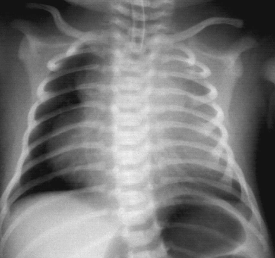 CPAM 3 típus (Stocker) I. Multicystás (50%) : nagy cysták > 20mm legjobb prognosis II.