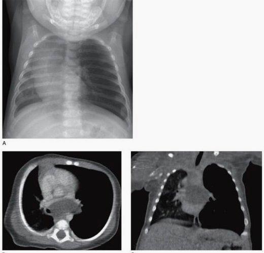 CLH differenciál diagnosis