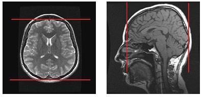 Sagittális síkú felvételen: a corpus callosum alsó pólusait összekötő egyenesre merőlegesen. Leképezés iránya: posteroanterior.