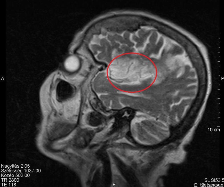 2.4.5.1. Ischemias stroke megjelenése a különböző szekvenciákban T1-súlyozott felvétel spin echo A T1-súlyozott képek leginkább az anatómiai viszonyok és a morfológiai adatok ábrázolására szolgálnak.