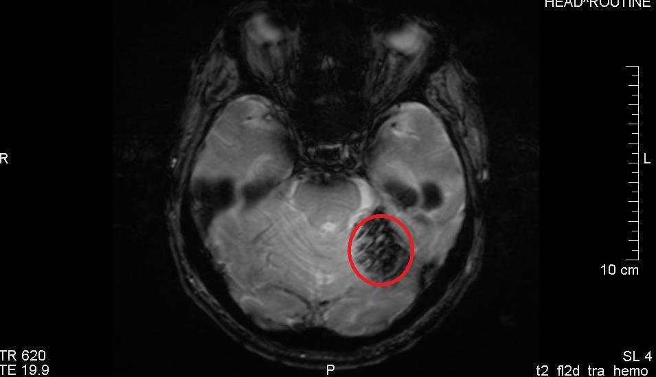 11. ábra. Vérzéses stroke hemogradiens MR felvétele, hypointenzitás Kontrasztanyagos MR szekvenciák A gadolinium kelátokat tartalmazó kontrasztanyag a relaxációs időt csökkenti.
