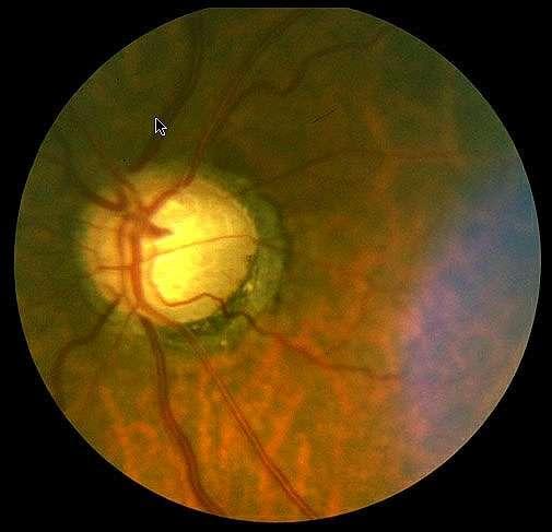 Glaucoma