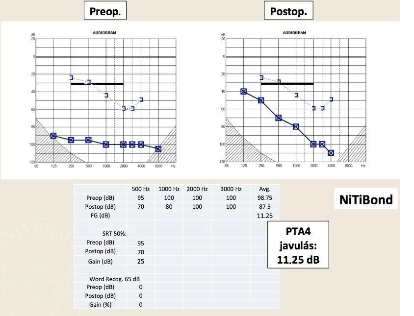 14. ábra: A power stapes eset műtét előtti audiogramja (Preop.