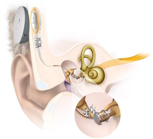 15. ábra: A Vibrant Soundbridge aktív középfül implantátum az incus hosszú szárra rögzített FMT-vel A műtétet követően szabad hangtérben mért átlagos légvezetéses küszöb 87.