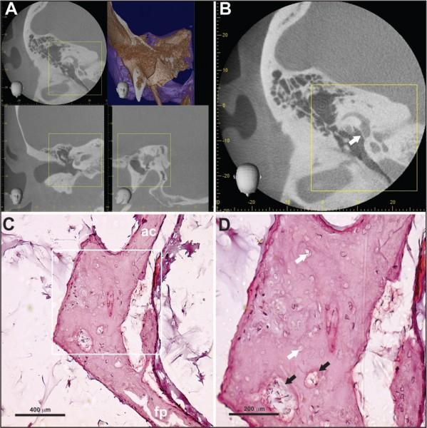 22. ábra CBCT kép szövettanilag inaktív otosclerosisban (jobb fül). Axiális, koronális és szagittális rekonstrukciójú CBCT felvételek (A). 0.