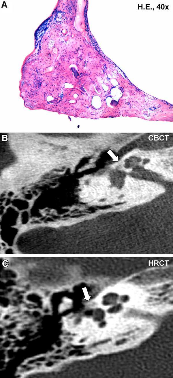 23. ábra Szövettanilag aktív otosclerosis (bal fül). Hipervascularisált otoscleroticus fókusz, a stapes talp elülső pólusán pseudovascularis terekkel. (HE) (A). CBCT axiális rekonstrukciója.