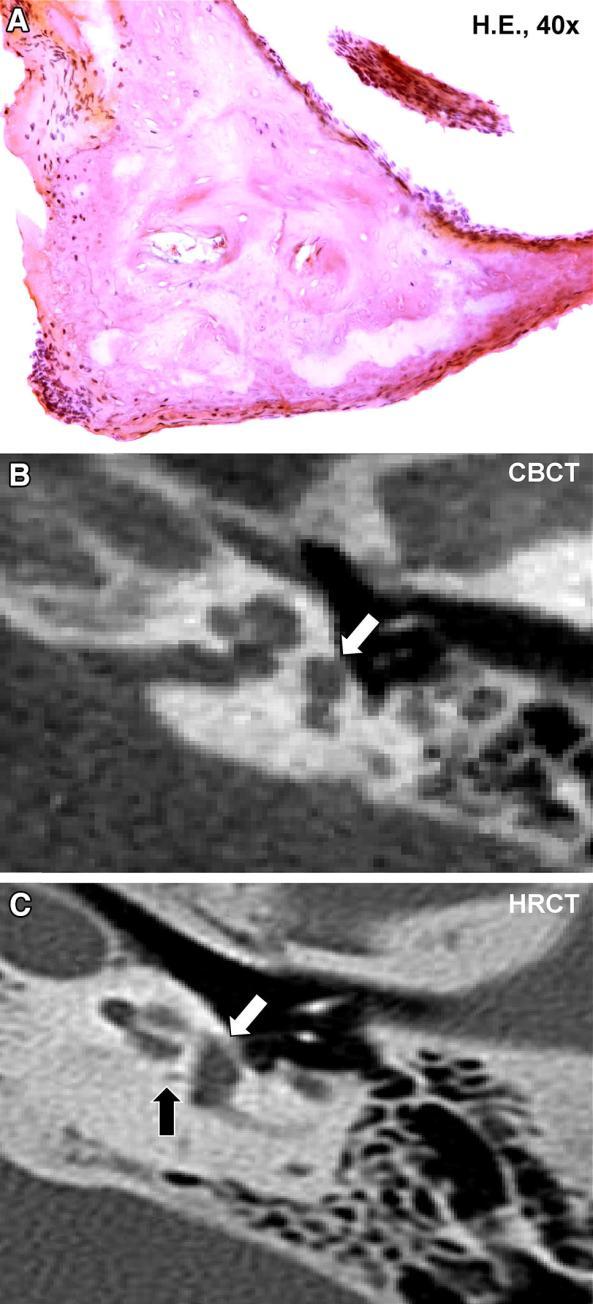 ábra Szövettanilag inaktív otosclerosis (jobb fül). Inaktív otoscleroticus lézió a stapes talp elülső pólusánál (HE).