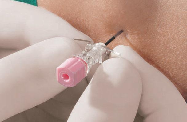 EPIDURÁLIS ANESZTÉZIA A LEGJOBB MINŐSÉGET ADJUK AZ ÖN KEZÉBE B.