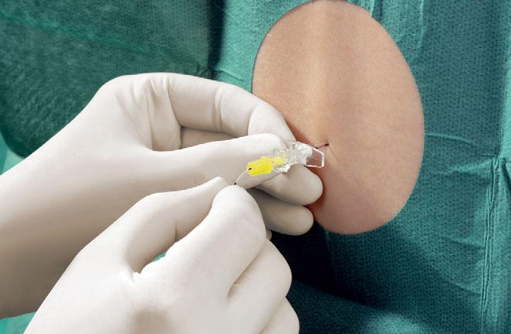 EPIDURÁLIS ANESZTÉZIA TOVÁBBFEJLESZTETT ESZKÖZTÁR KIS BETEGEK SZÁMÁRA A LEGFINOMABB ELJÁRÁSOK A LEGFEJLETTEBB ESZKÖZÖK HASZNÁLATÁT IGÉNYLIK Az elmúlt évtizedben a gyermekeken végzett regionális