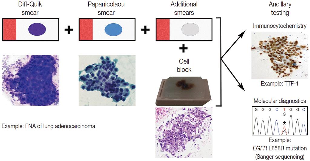 The Utilization of Cytologic Fine-Needle Aspirates of Lung Cancer for Molecular Diagnostic