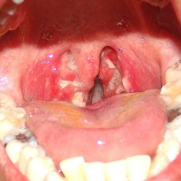 Pharyngitis virosa Igen gyakori. Ha adenovírusok okozzák, conjunctivitis is fennállhat.