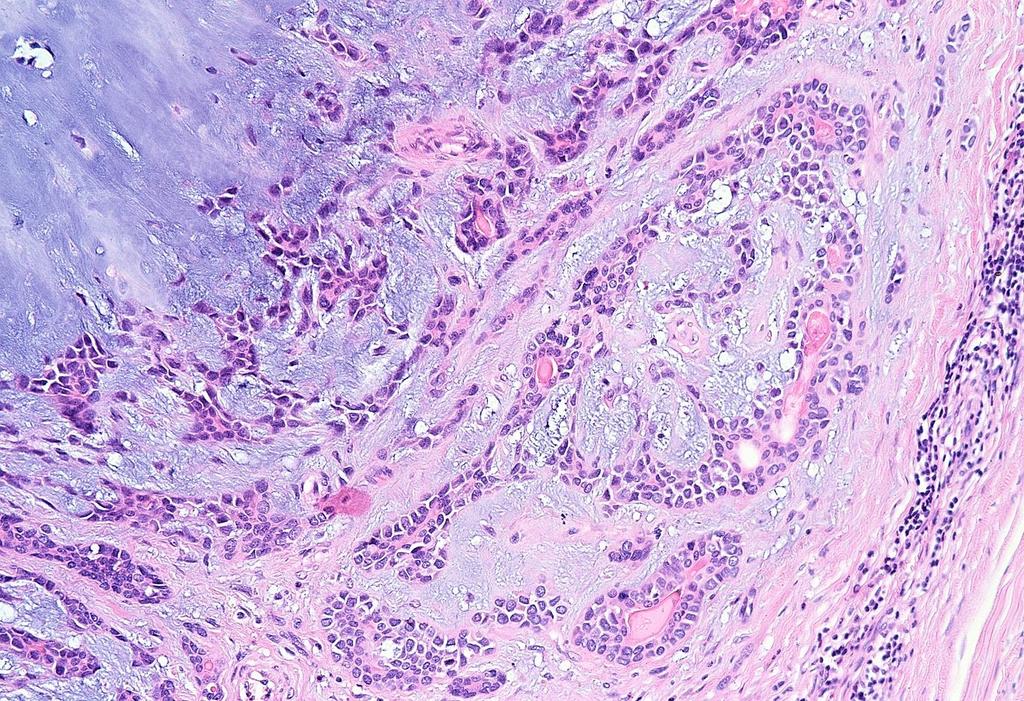 Pleiomorph adenoma: myoepithelialis és