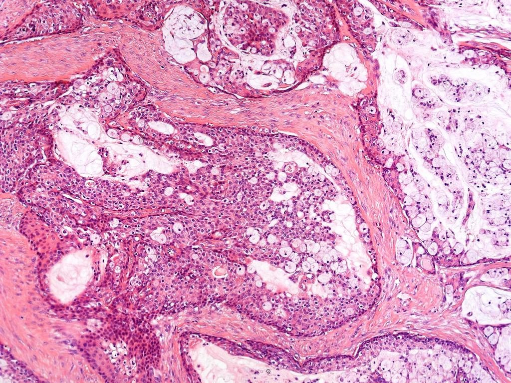 Mucoepidermoid carcinoma, low