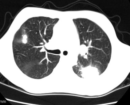 CT Tüdıparenchyma betegségei Mediastinum