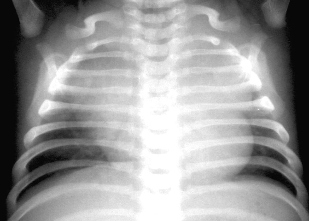 interpretáció A normális thymus nem komprimálja a