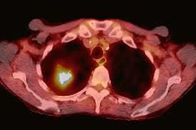 PET-CT
