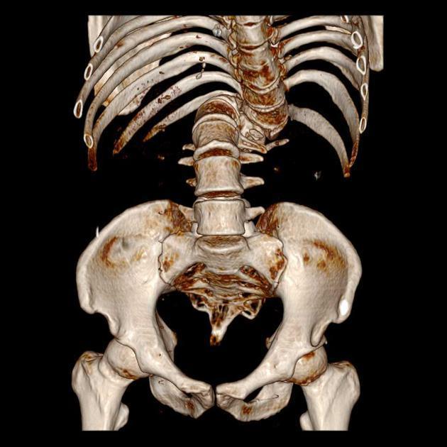 Scoliosis