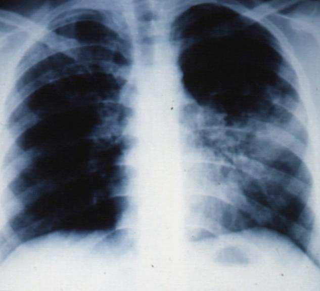 Pneumonia