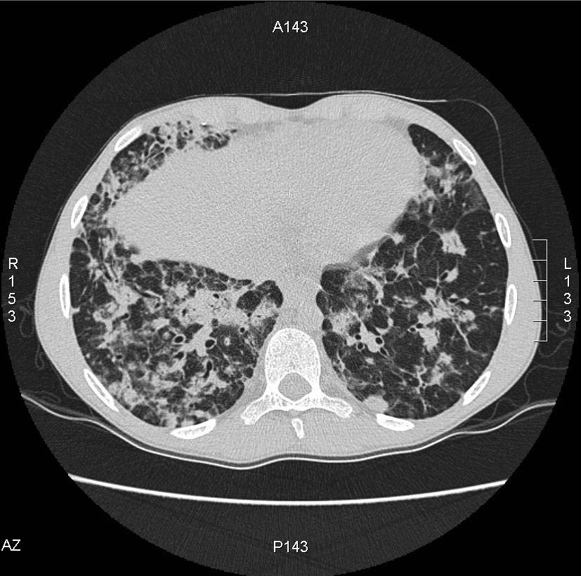 splenomegália és csökkenő thr szám Mellkas CT kontroll (2015