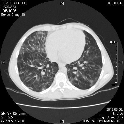 Granulomás tüdőbetegség (GLILD) 2. Kontroll CT (2015. 03. 29.