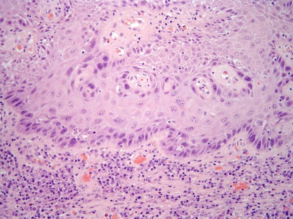 Differenciált intraepithelialisneoplasia (dvin, dpein) Basalisatípia: csak az alsó 2-3 sejtsorban (bár a sejtek genetikailag