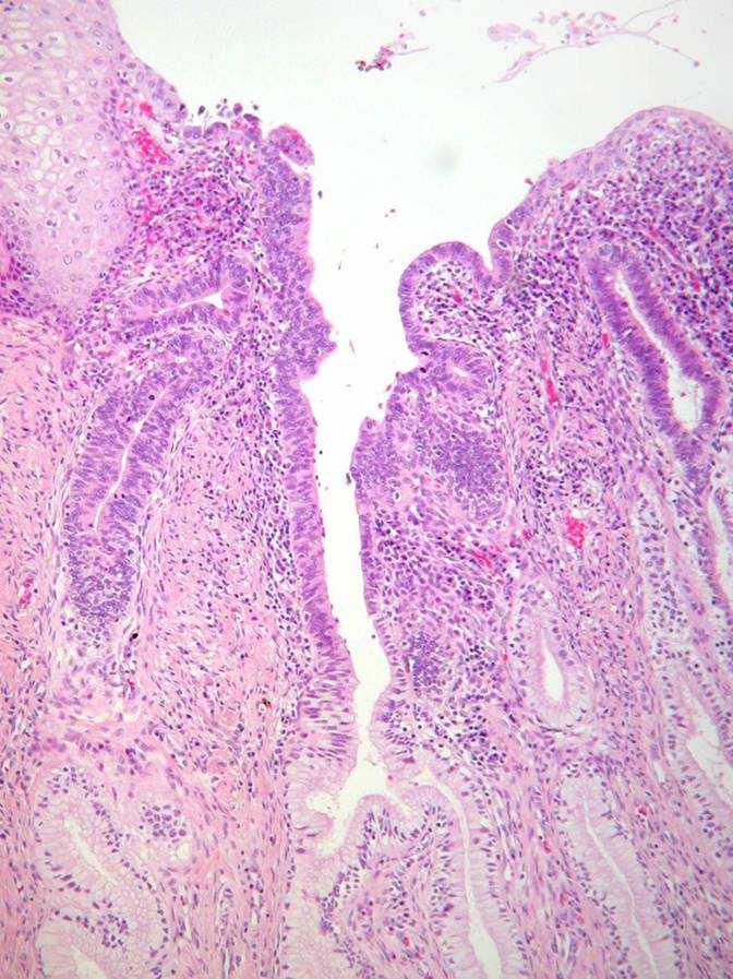 Cervicalisglandularisintraepithelialis Nincs